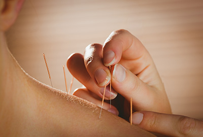 acupuncture image