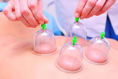 cupping therapy