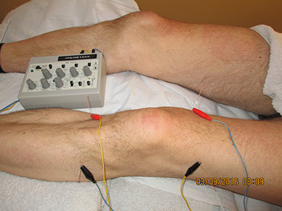 electro acupuncture on knee image